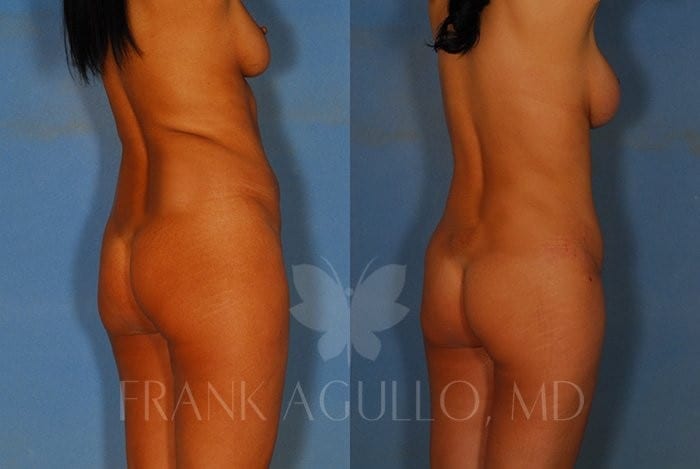 Tummy Tuck Before and After 6