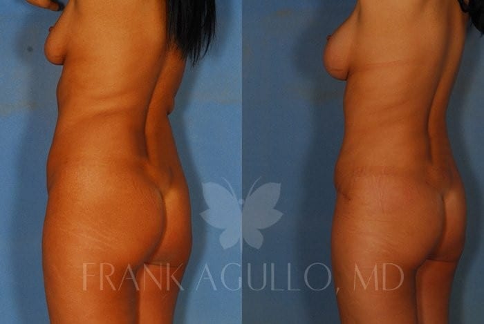 Tummy Tuck Before and After 7