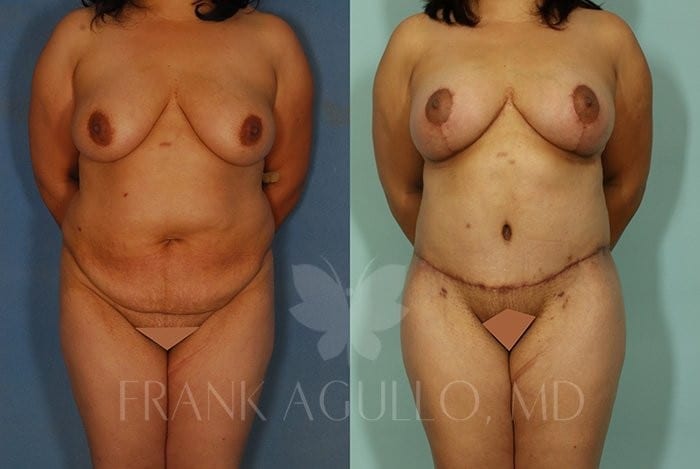 Tummy Tuck Before and After 2