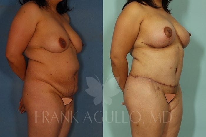 Tummy Tuck Before and After 2