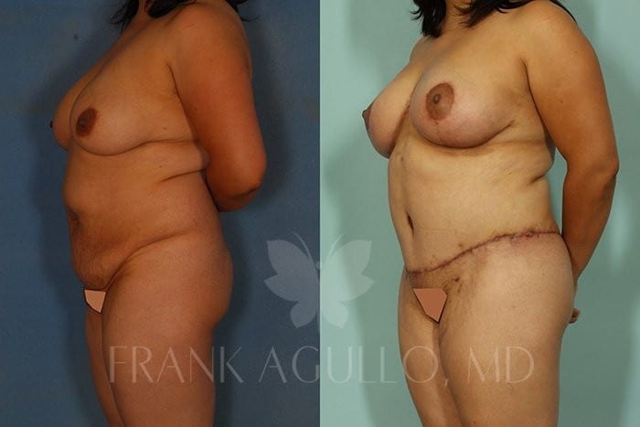 Tummy Tuck Before and After 3