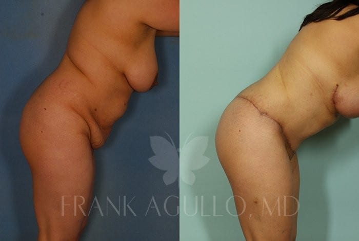Tummy Tuck Before and After 4