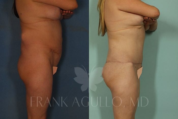 Tummy Tuck Before and After 1