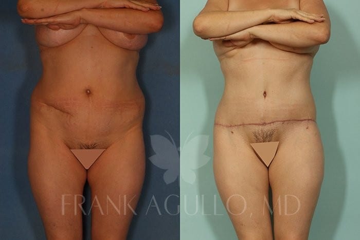 Tummy Tuck Before and After 2