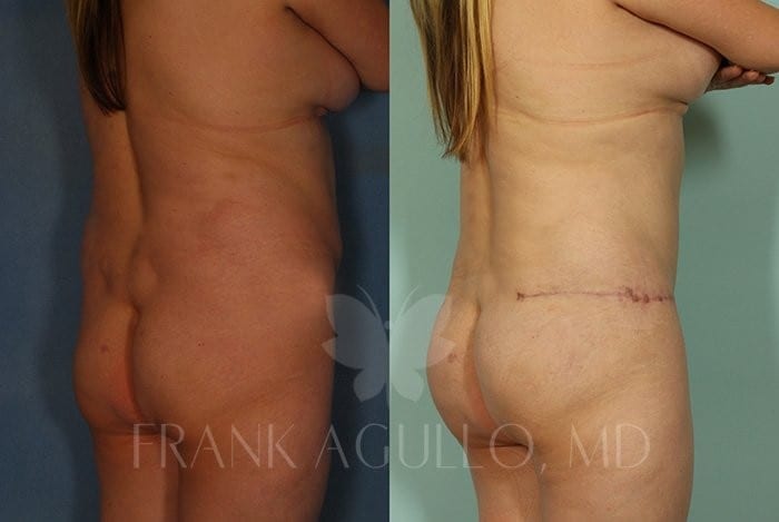 Tummy Tuck Before and After 3