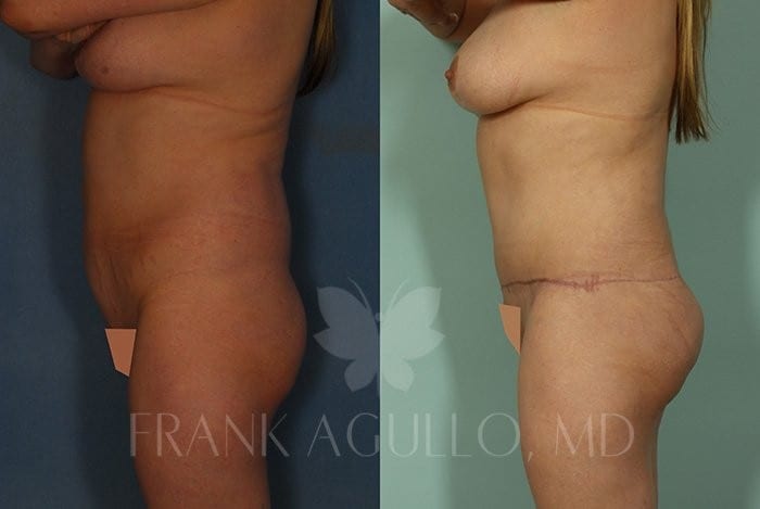 Tummy Tuck Before and After 4