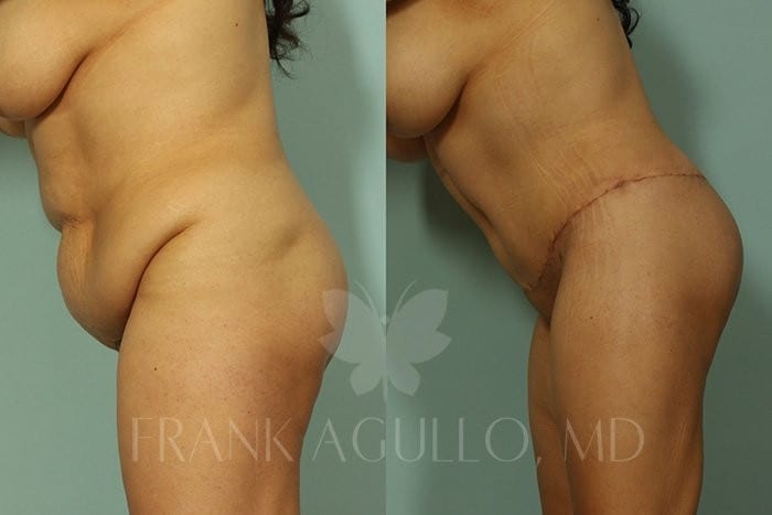 Tummy Tuck Before and After 20