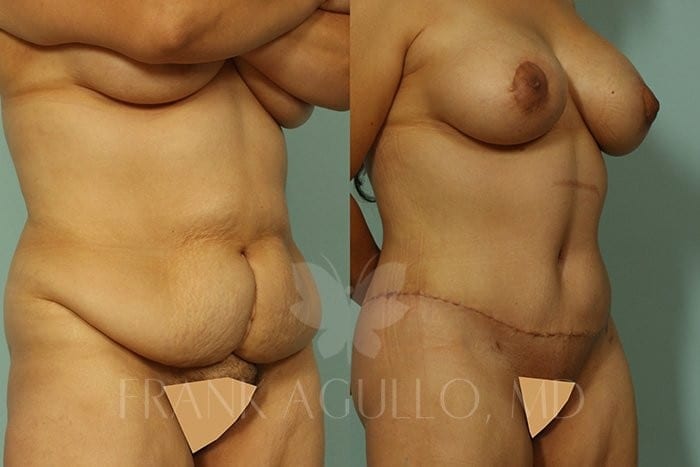Tummy Tuck Before and After 2