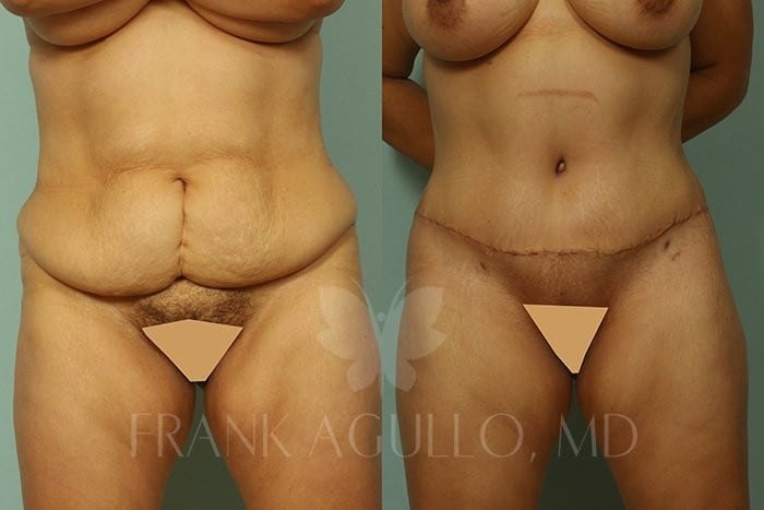Tummy Tuck Before and After 3