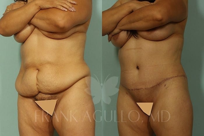 Tummy Tuck Before and After 4