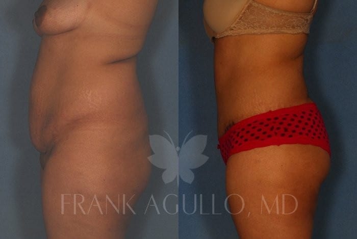 Tummy Tuck Before and After 19