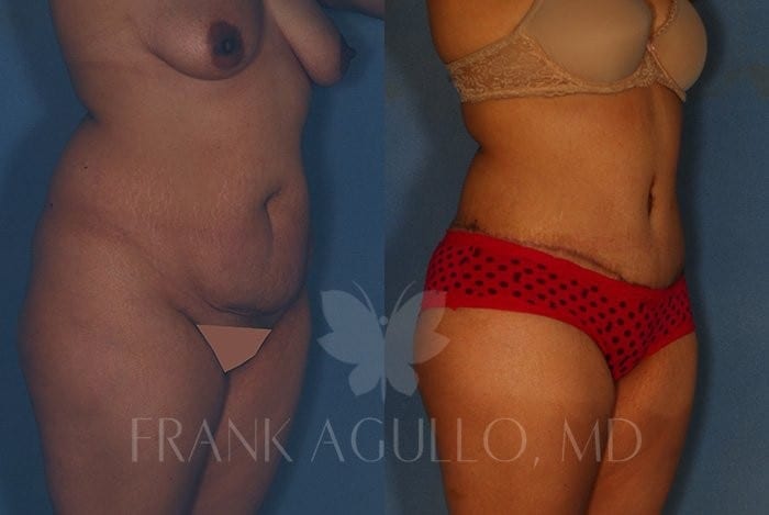 Tummy Tuck Before and After 2