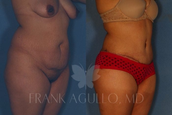 Tummy Tuck Before and After 3