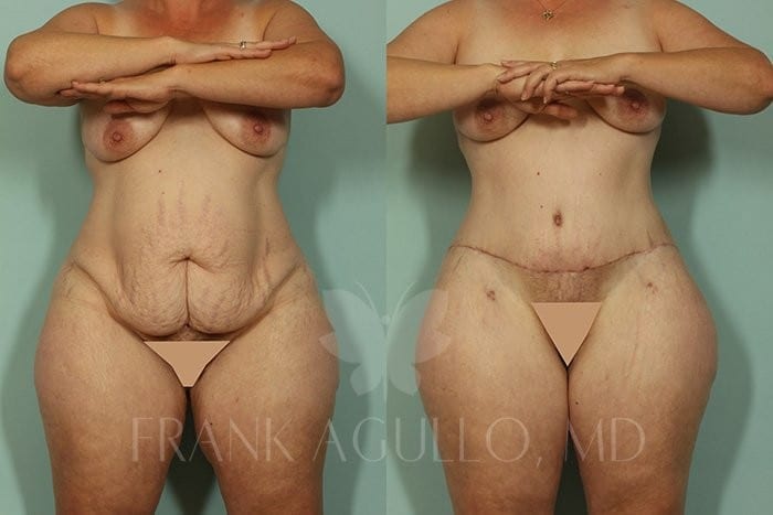 Tummy Tuck Before and After 17