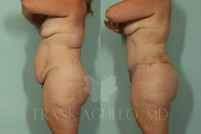 Tummy Tuck Before and After 5