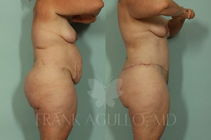 Tummy Tuck Before and After 4