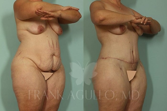 Tummy Tuck Before and After 2