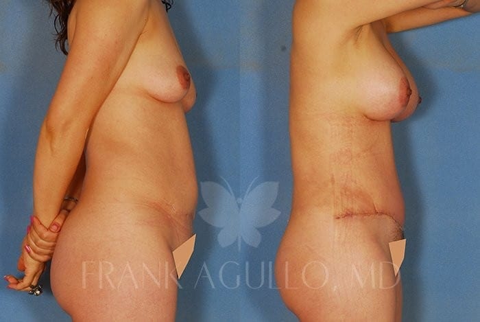 Tummy Tuck Before and After 2