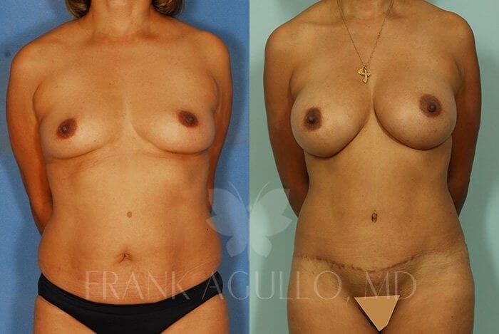 Tummy Tuck Before and After 11