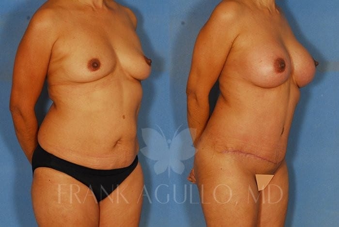 Tummy Tuck Before and After 2