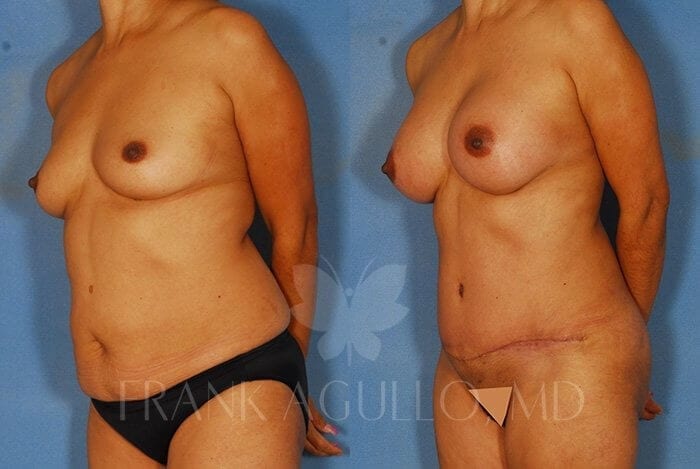 Tummy Tuck Before and After 3