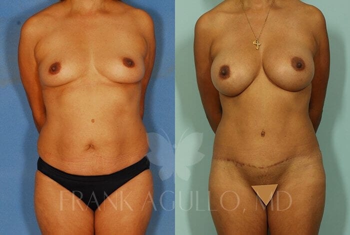 Tummy Tuck Before and After 4