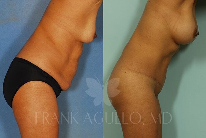 Tummy Tuck Before and After 5