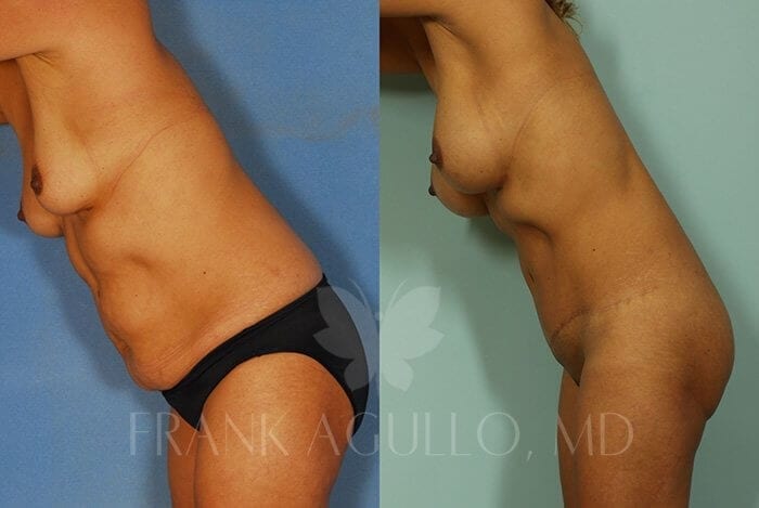 Tummy Tuck Before and After 6