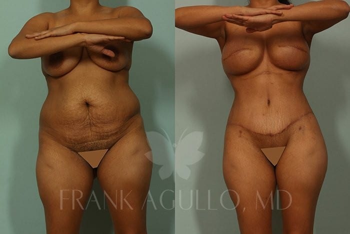 Tummy Tuck Before and After 15