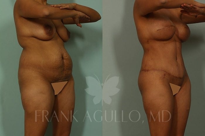 Tummy Tuck Before and After 2