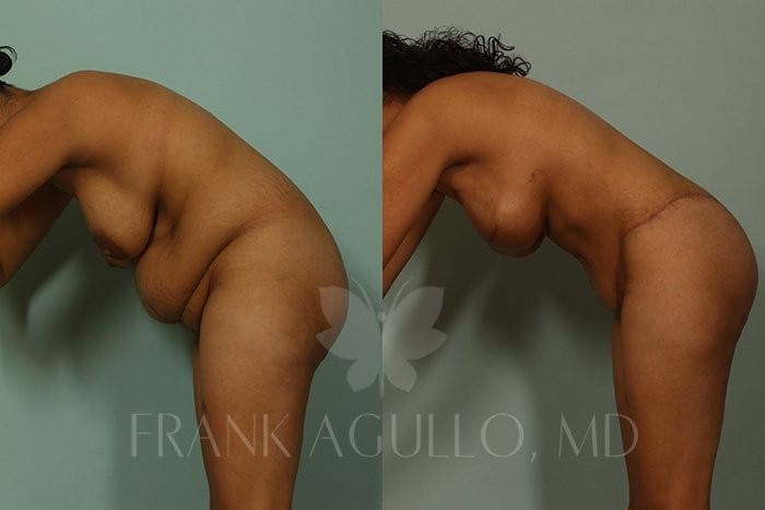 Tummy Tuck Before and After 3