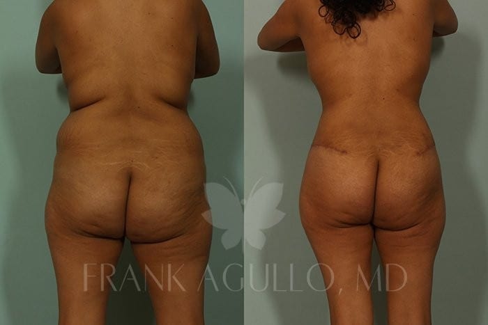 Tummy Tuck Before and After 4