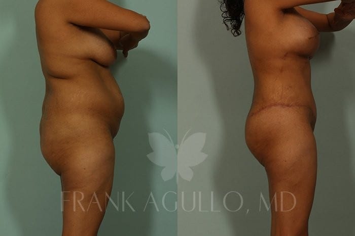 Tummy Tuck Before and After 5