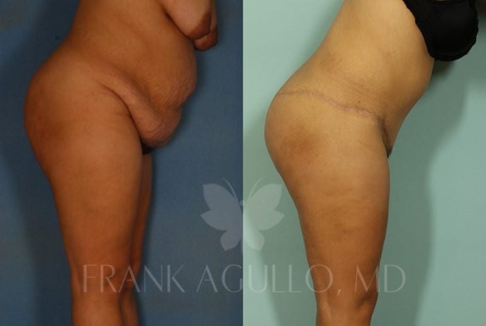 Tummy Tuck Before and After 14