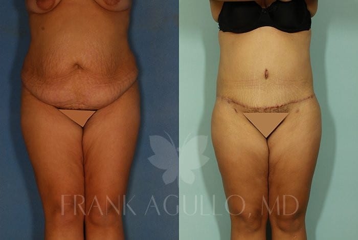 Tummy Tuck Before and After 2
