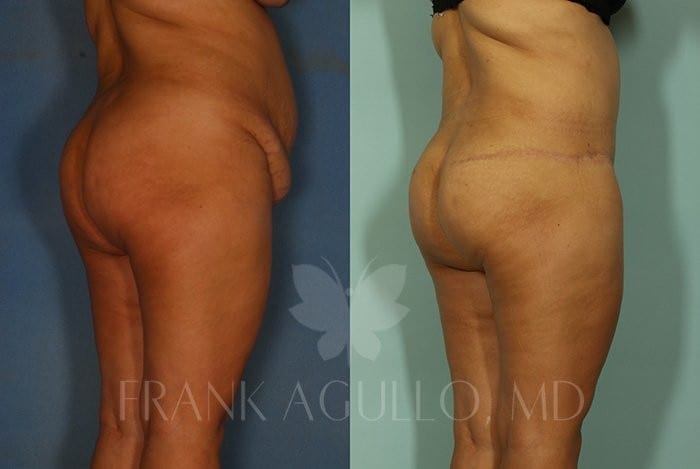 Tummy Tuck Before and After 3