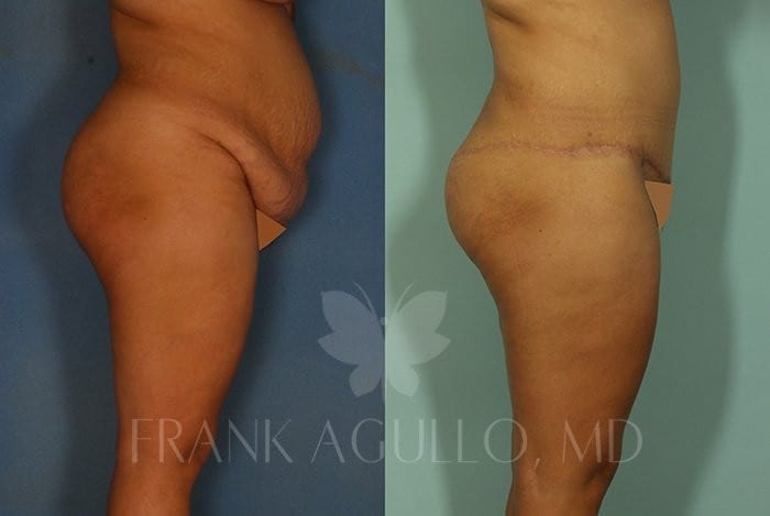 Tummy Tuck Before and After 4