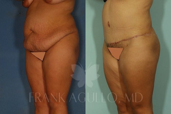 Tummy Tuck Before and After 5