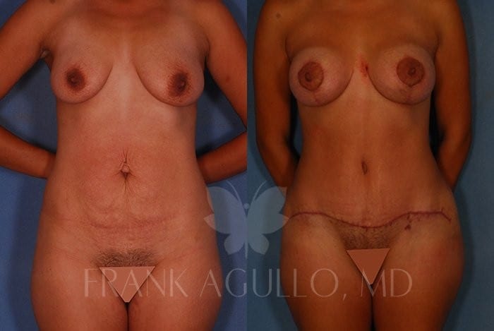 Tummy Tuck Before and After 5