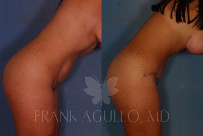 Tummy Tuck Before and After 6