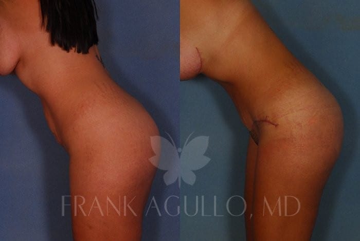 Tummy Tuck Before and After 7