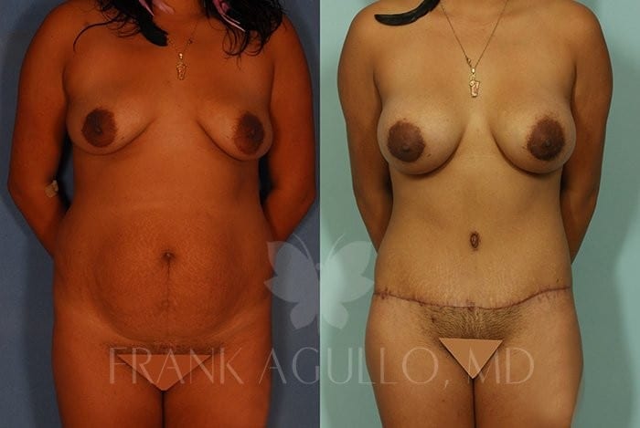 Tummy Tuck Before and After 12