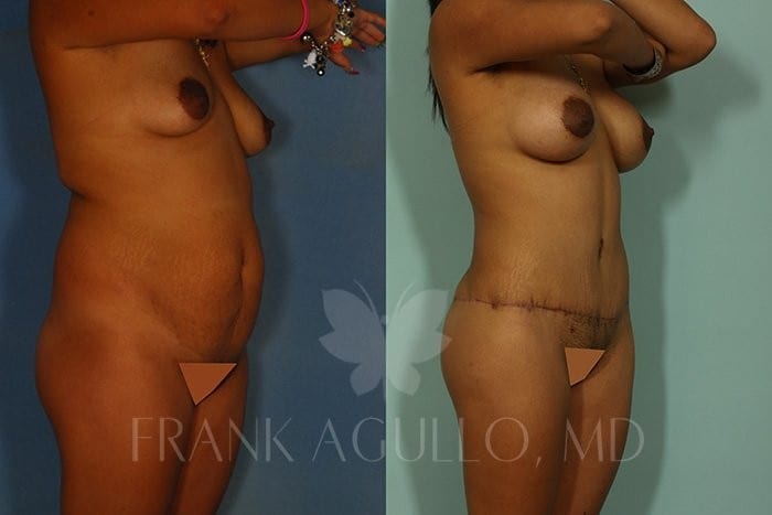 Tummy Tuck Before and After 3