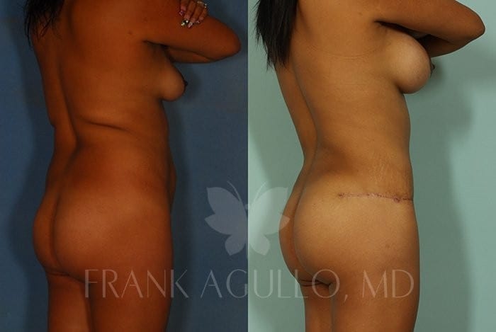 Tummy Tuck Before and After 4