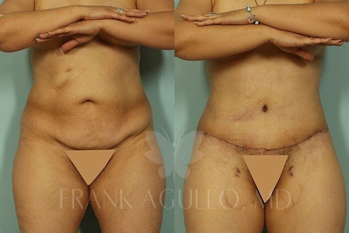 Tummy Tuck Before and After 10