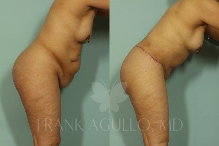 Tummy Tuck Before and After 3