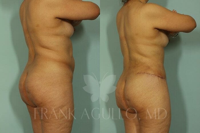 Tummy Tuck Before and After 4