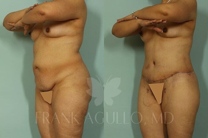 Tummy Tuck Before and After 5