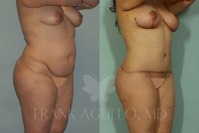 Tummy Tuck Before and After 9