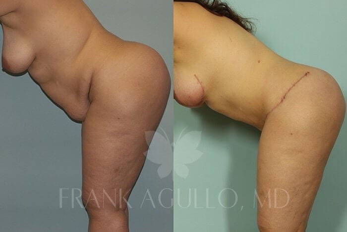 Tummy Tuck Before and After 2